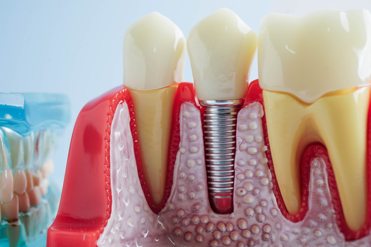 Dental Implants Davis