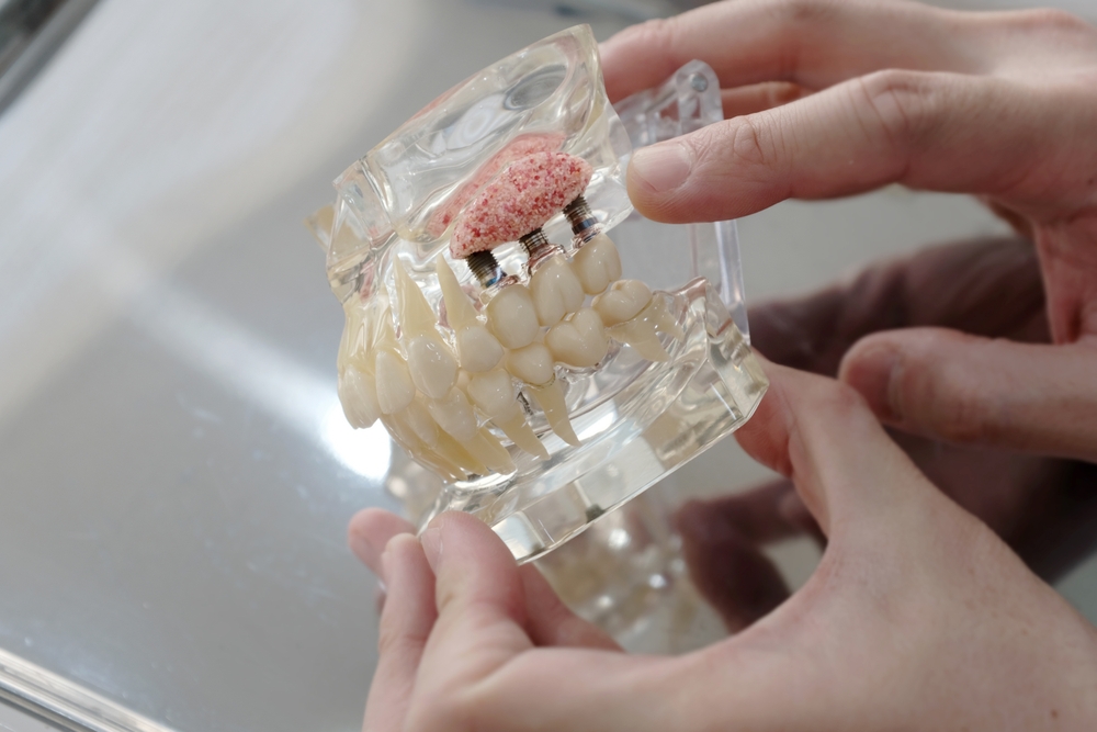 Bone Grafts and Sinus Lifts in Davis, CA. Dr. Amir Nojouimi, Dr. Pouya Namiranian. Davis Oral Surgery & Implant Center