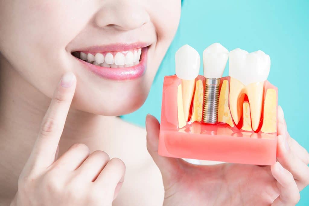 Am I A Candidate for Dental Implants